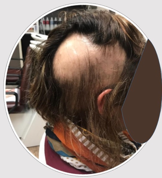 perruque alopecie